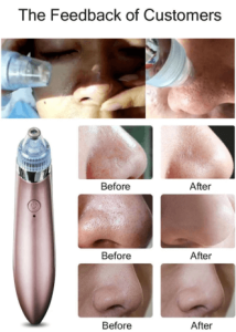 XN 8030 Beauty Skin Care Expert Acne Pore Cleaner