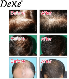 Dexe Anti-hair Loss lotion 6ml 10