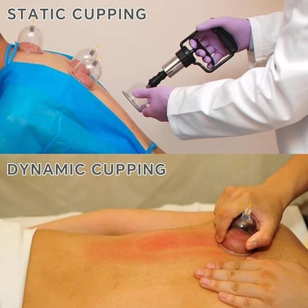 Hijama Kit 12 Pcs Cups